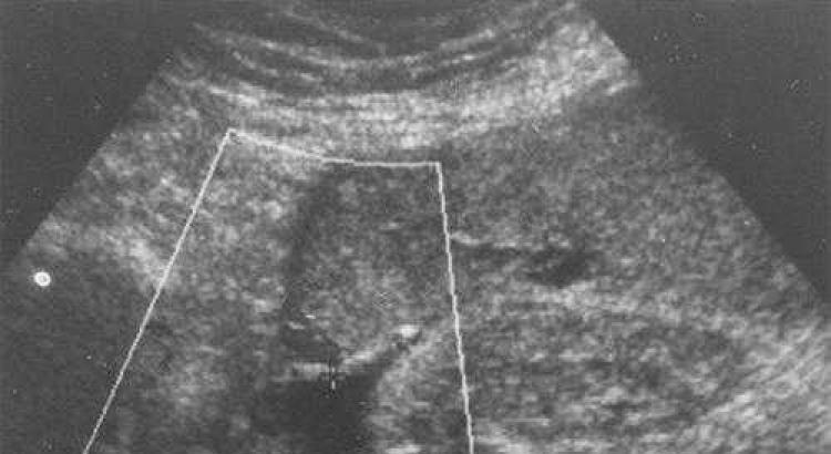 Нормы индекса амниотической жидкости по неделям беременности Норма околоплодных вод в 33